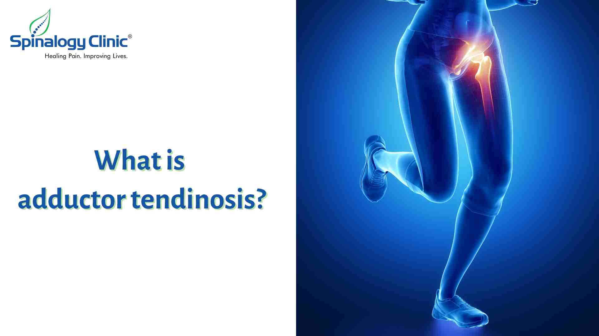 What is adductor tendinosis?